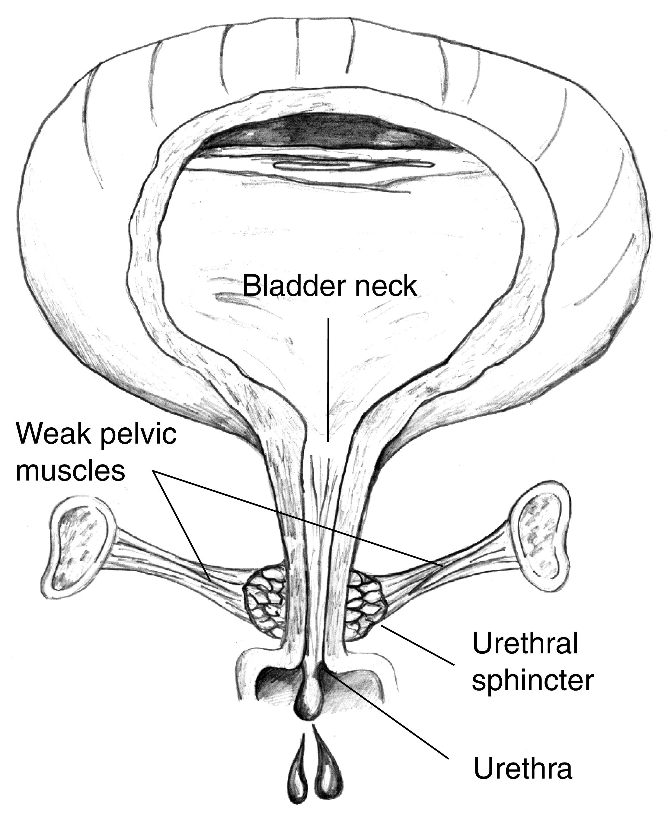 Laparoscopic Burch Colposuspension in Pune – Advanced Surgery for Urinary Incontinence